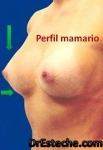 Que son los implantes mamarios y cuáles son los tipos de implantes mamarios