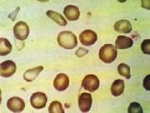 ¿Qué es la anemia de Cooley? 