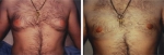 Liposucción para el pecho masculino o senos masculinos.