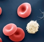 ¿Qué es la anemia crónica?