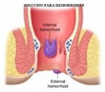 Sintomas de las Hemorroides