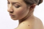Cómo las verrugas y lunares en tu piel afectan la autoestima.