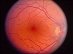 Salud Ocular – Desprendimiento de Retina