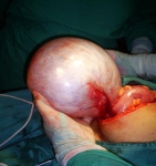 Cirugía Para Los Quistes De Ovario