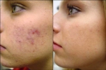 El acne, como y donde se origina