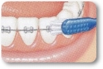 Higiene en Ortodoncia