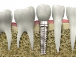 Los implantes dentales: últimos avances