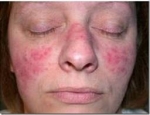 Tratamientos para el acné - ¿Qué tratamientos son los mejores para la limpieza del acné?