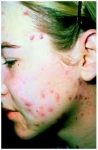 Remedio para quitar el acne - Concejos para eliminar el acne con tratamientos caceros