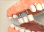 Prótesis dentales: tipos y cuidados higiénicos de las mismas.