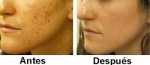 Cómo eliminar el acné de su piel sin usar productos químicos 