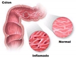 Tratamiento natural de la enfermedad de Crohn con la vitamina D: Investigación 