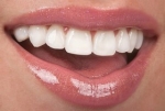 Las carillas dentales