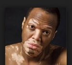 El vitiligo es curable: el papel de la dieta