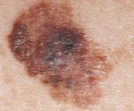 El cáncer de piel y sus efectos en el organismo